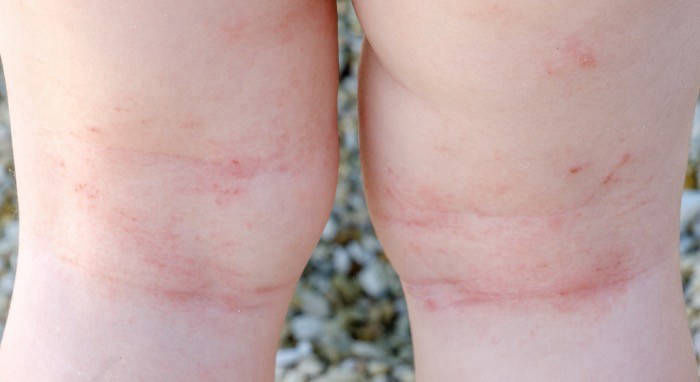 Atopijski dermatitis i ekcem kod beba