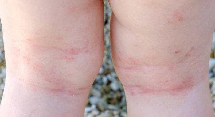 Atopijski dermatitis i ekcem kod beba